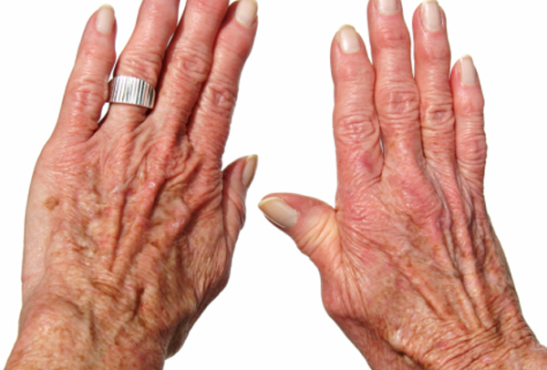 Rheumatoid-Arthritis